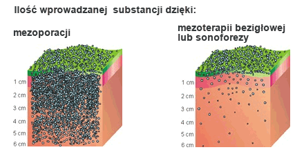 mezoterapia